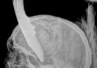 Homem de Alta Floresta passa por cirurgia após ser atacado com canivete