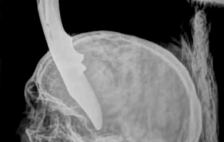 Homem de Alta Floresta passa por cirurgia após ser atacado com canivete