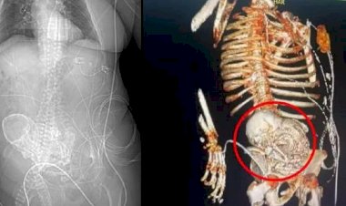 Idosa descobre que carregou “feto de pedra” por mais de 50 anos e morre após cirurgia de retirada